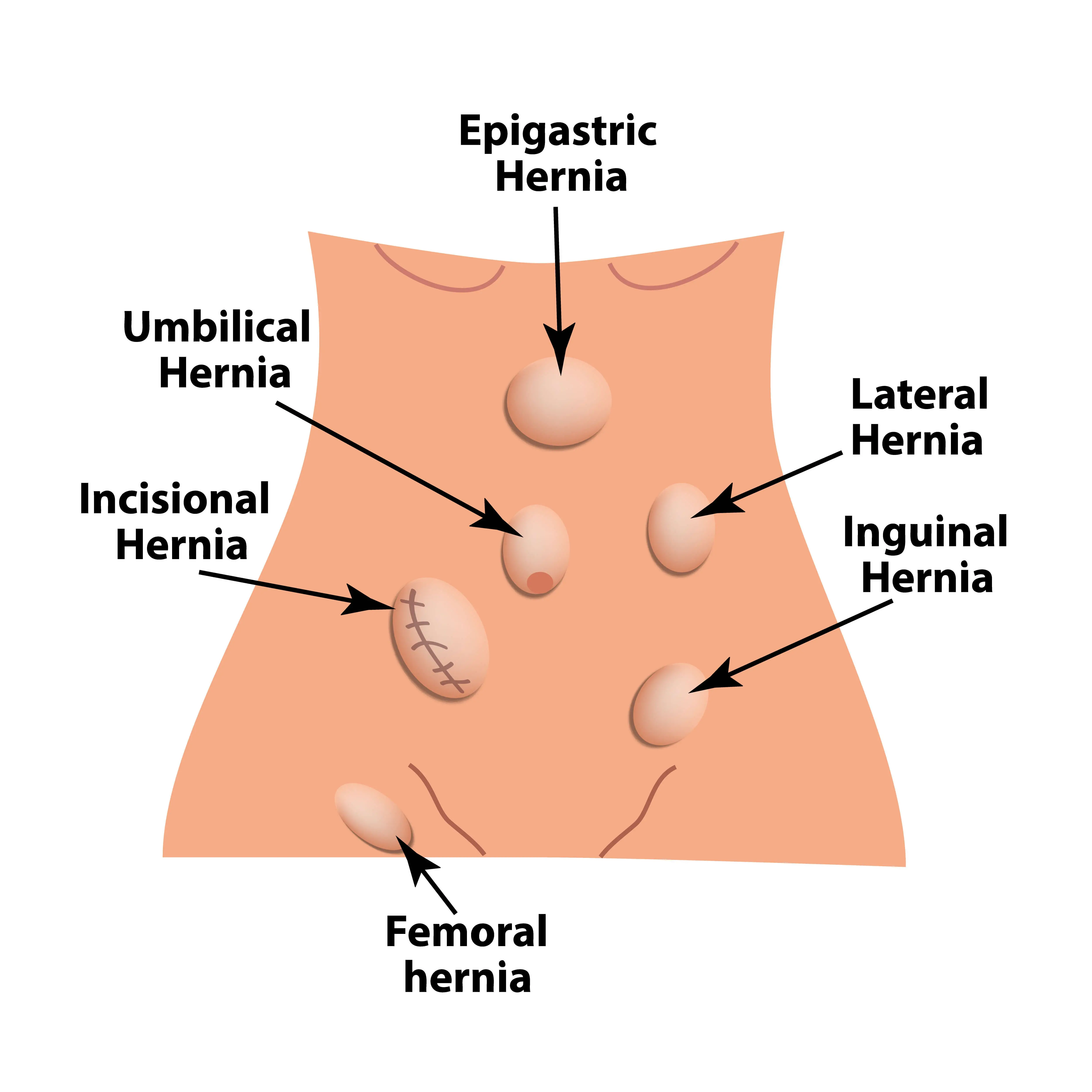 Hernias can occur in many parts of the body.
