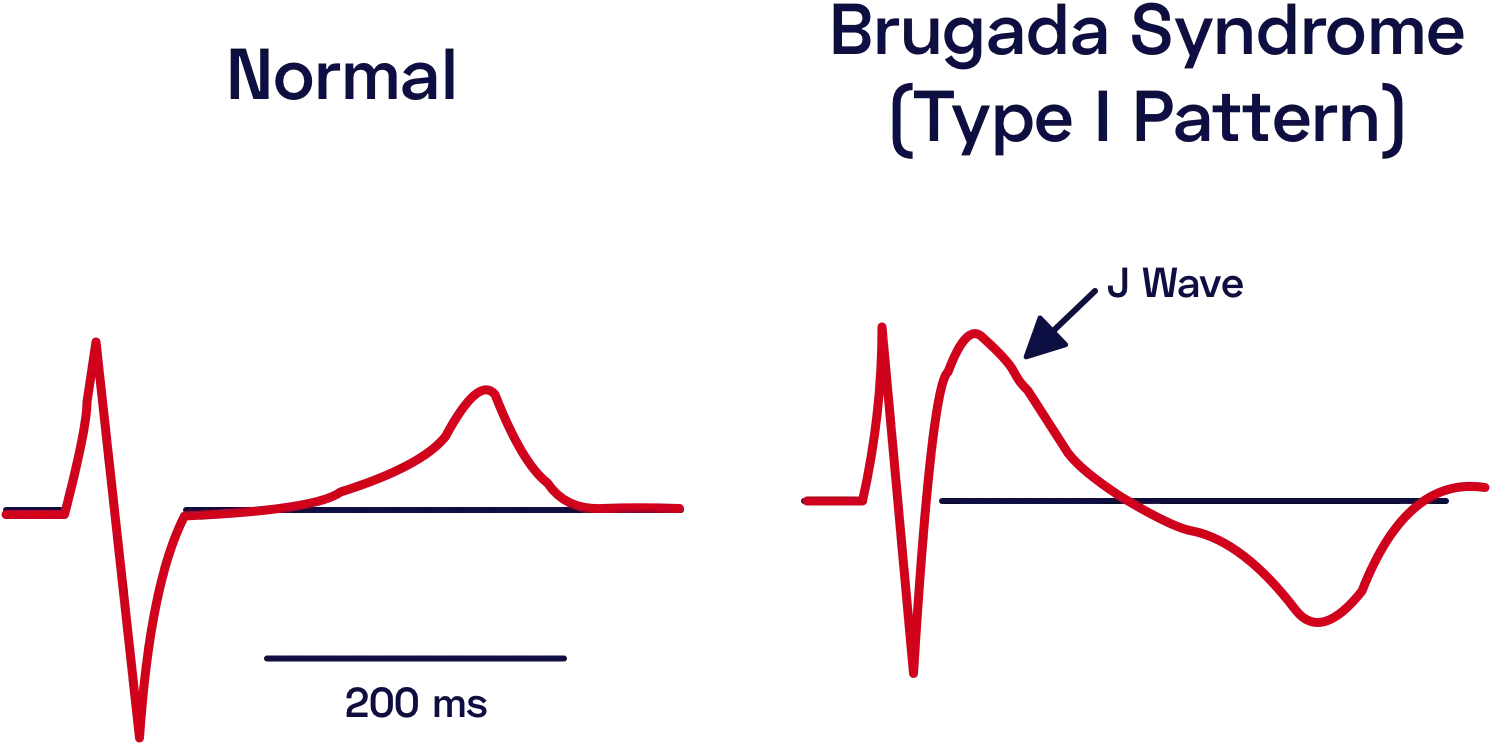 The characteristic electrocardiogram pattern of the Brugada syndrome.