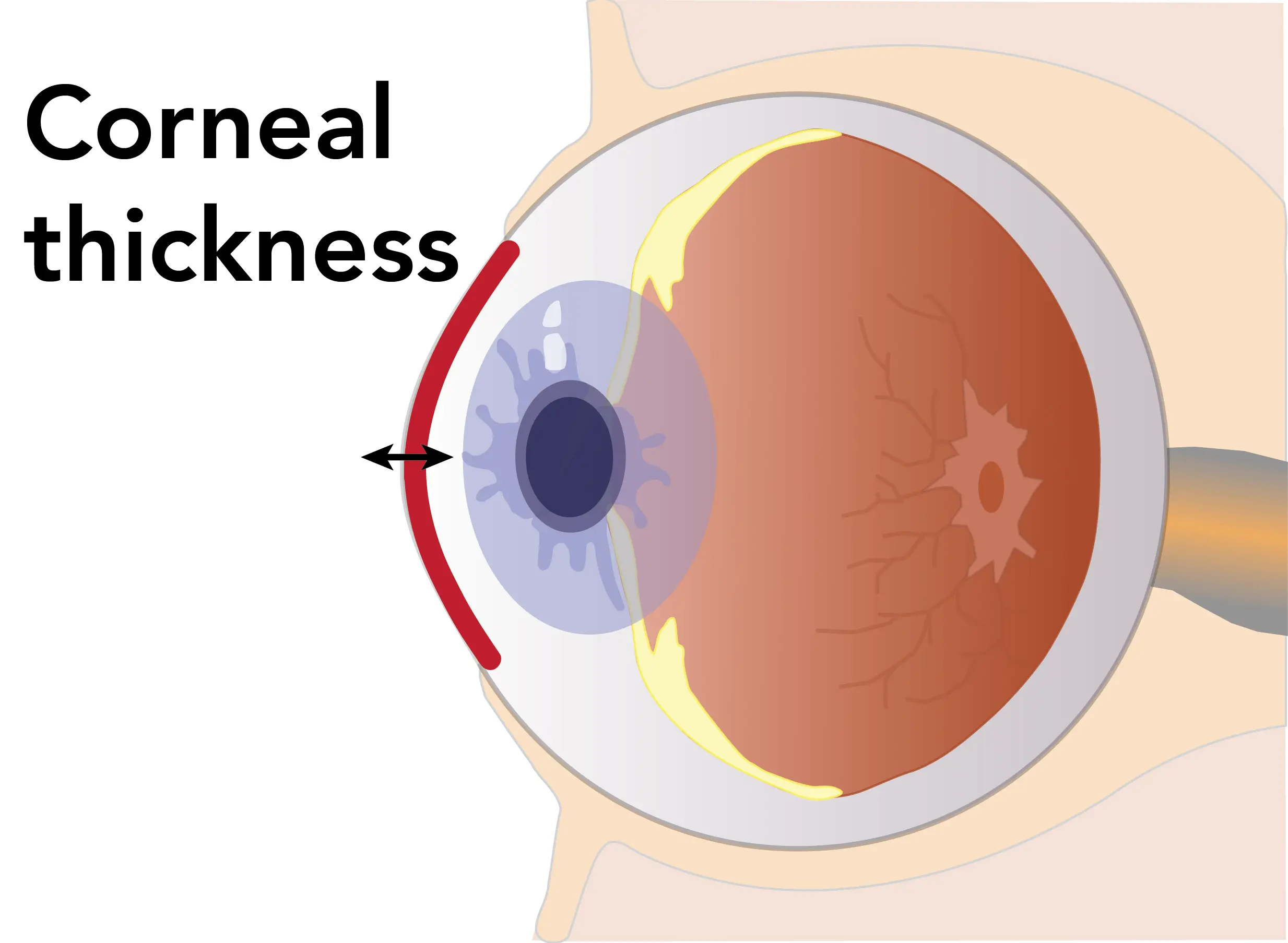 A normal cornea is approximately 0.5 millimiters thick at the center.