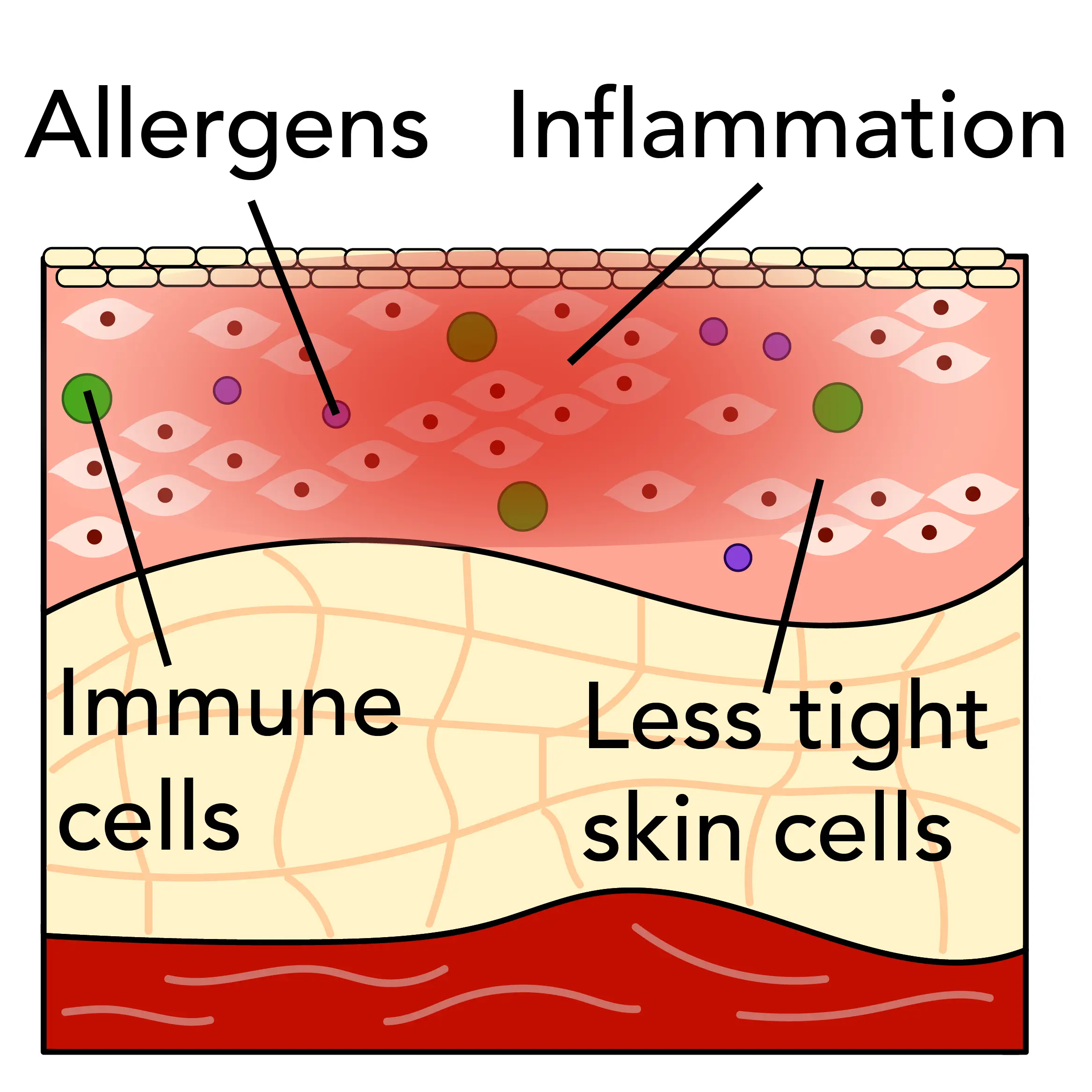 Atopic dermatitis is caused by immune cells in the skin that respond to contact with allergens.