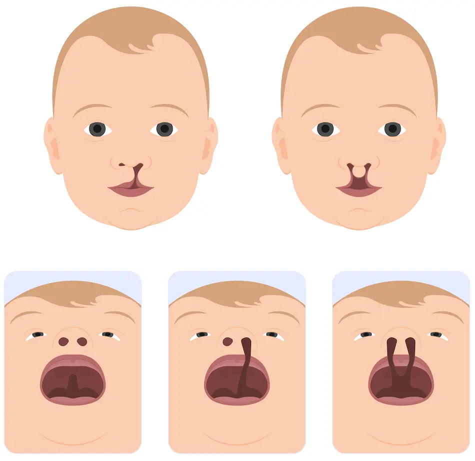 Types of orofacial clefts.