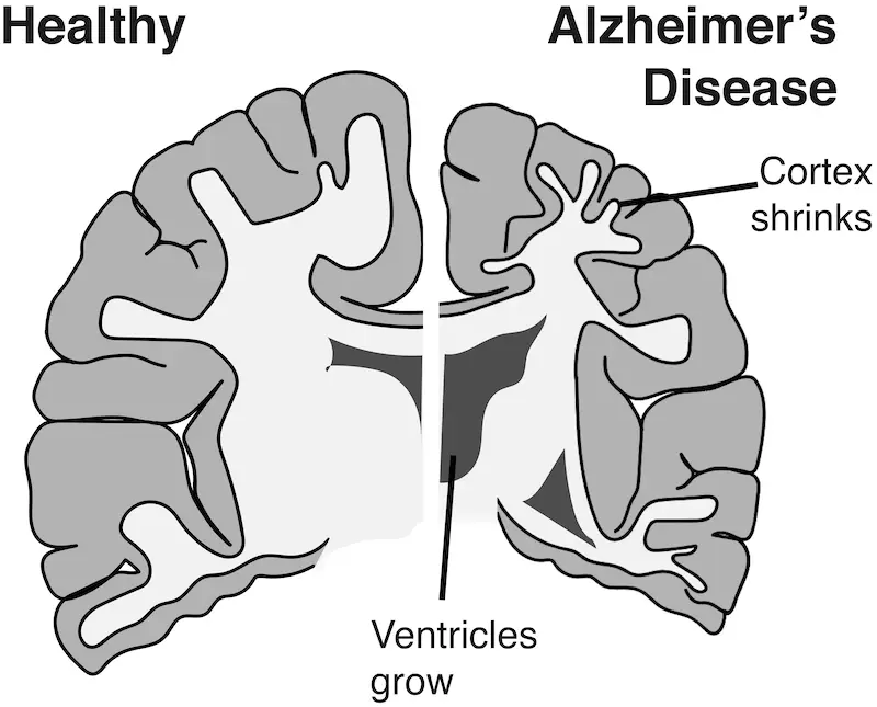Some people don't show cognitive decline despite Alzheimer's-typical degeneration in the brain.
