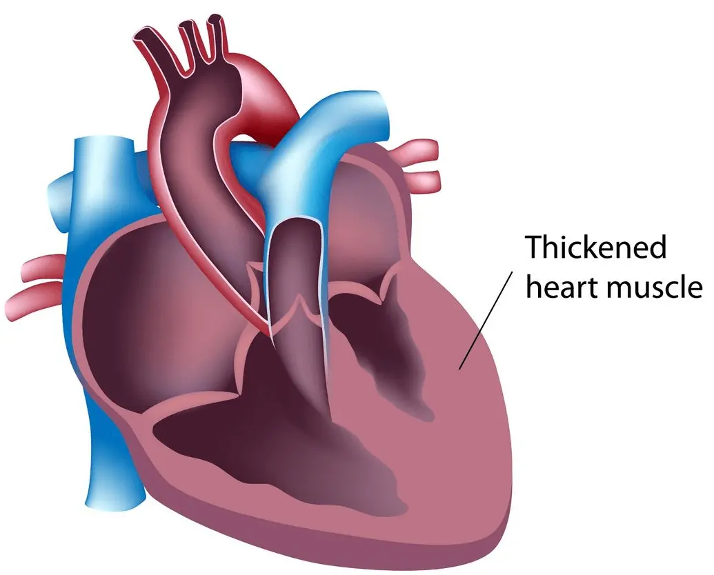 Hypertrophic cardiomyopathy is caused by a thickening of the heart muscle.