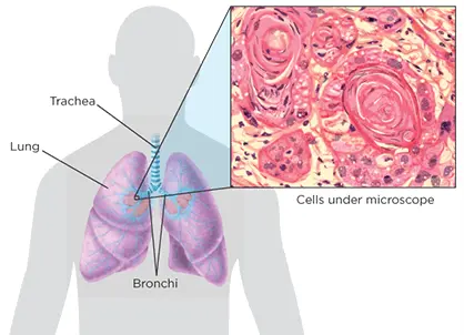 Squamous cell cancer of the lungs is often caused by smoking.