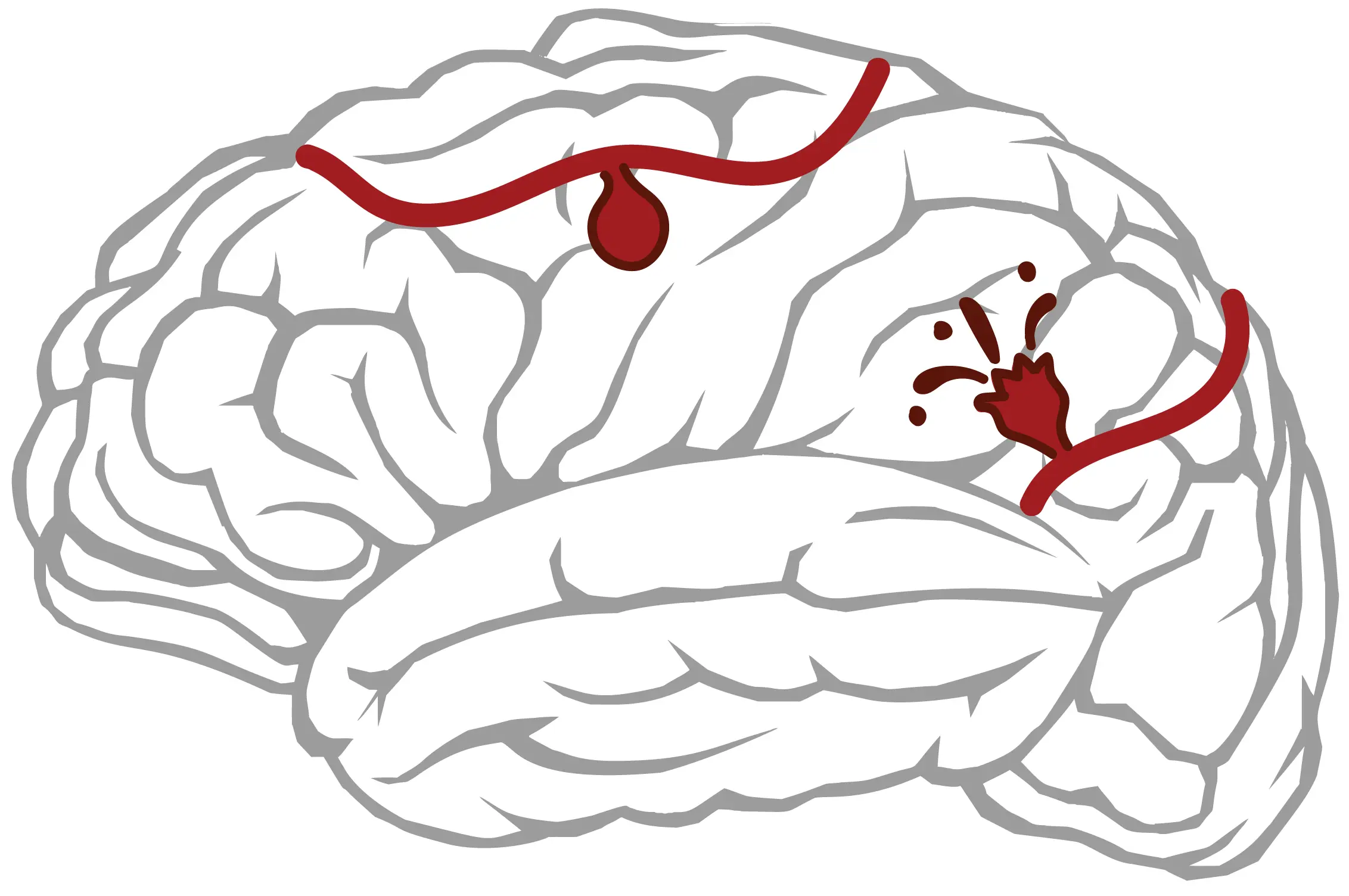 Brain aneurysms are blood vessels in the brain that are ballooned outward and filled with blood.