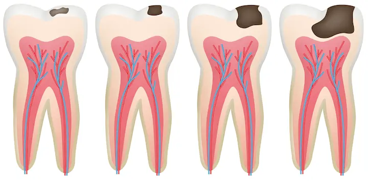 Tooth cavities start small but if left untreated will destroy an entire tooth.