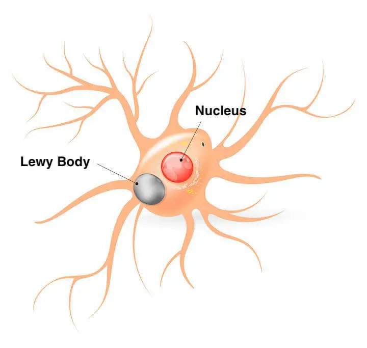 Lewy bodies are clumps of proteins that form inside nerve cells and damage them.