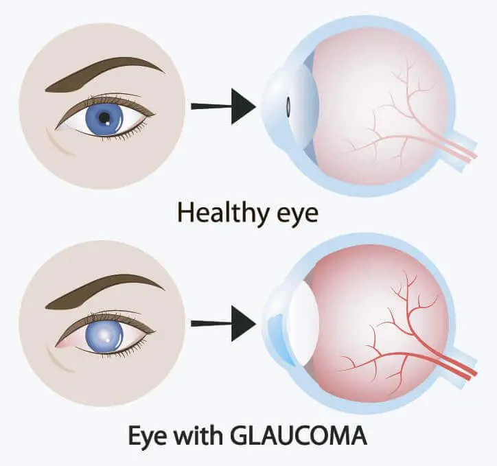 Glaucoma is typically caused by a blockage of a drainage canal in the eye which leads to fluid build up, increase in eye pressure and damage to the optic nerve.