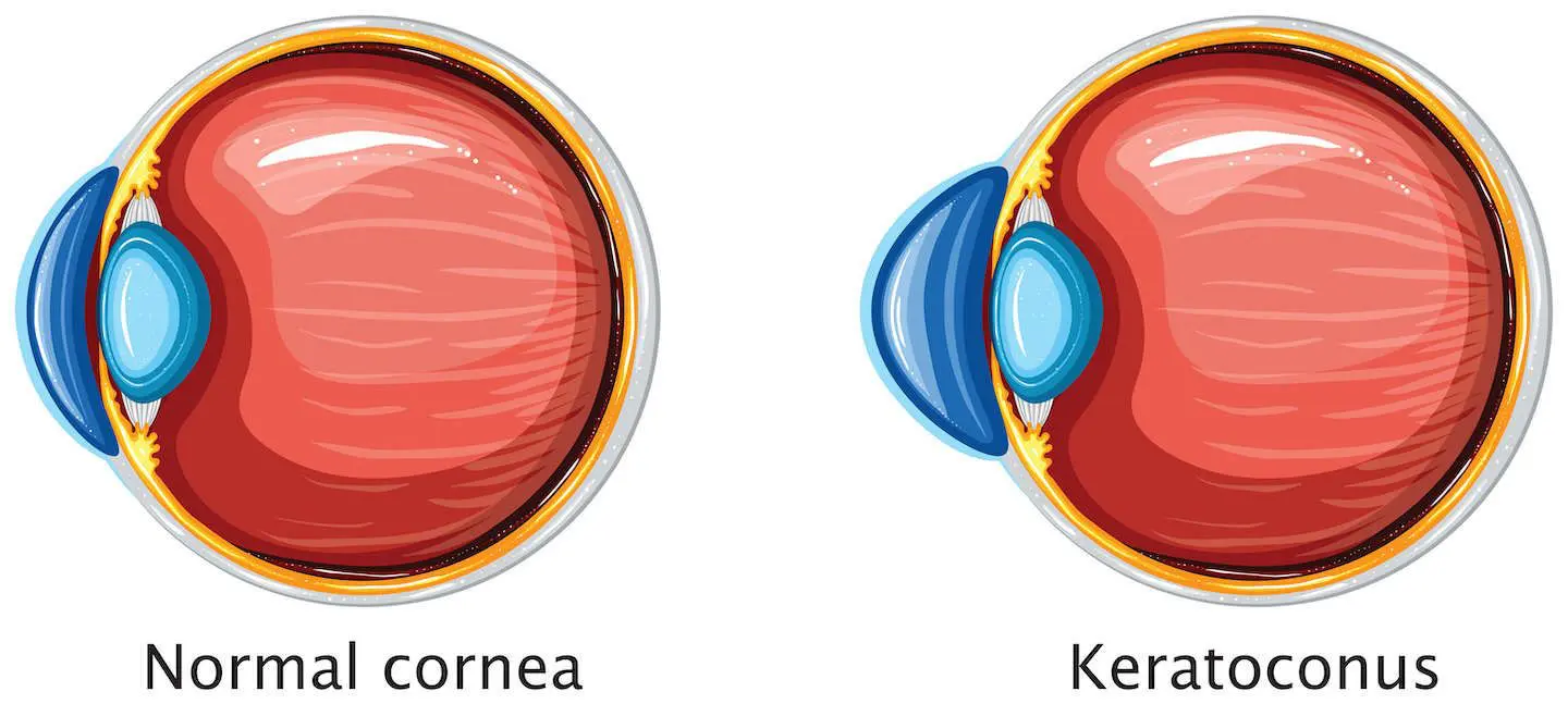 Changed shape of the cornea that is typically observed in keratoconus.