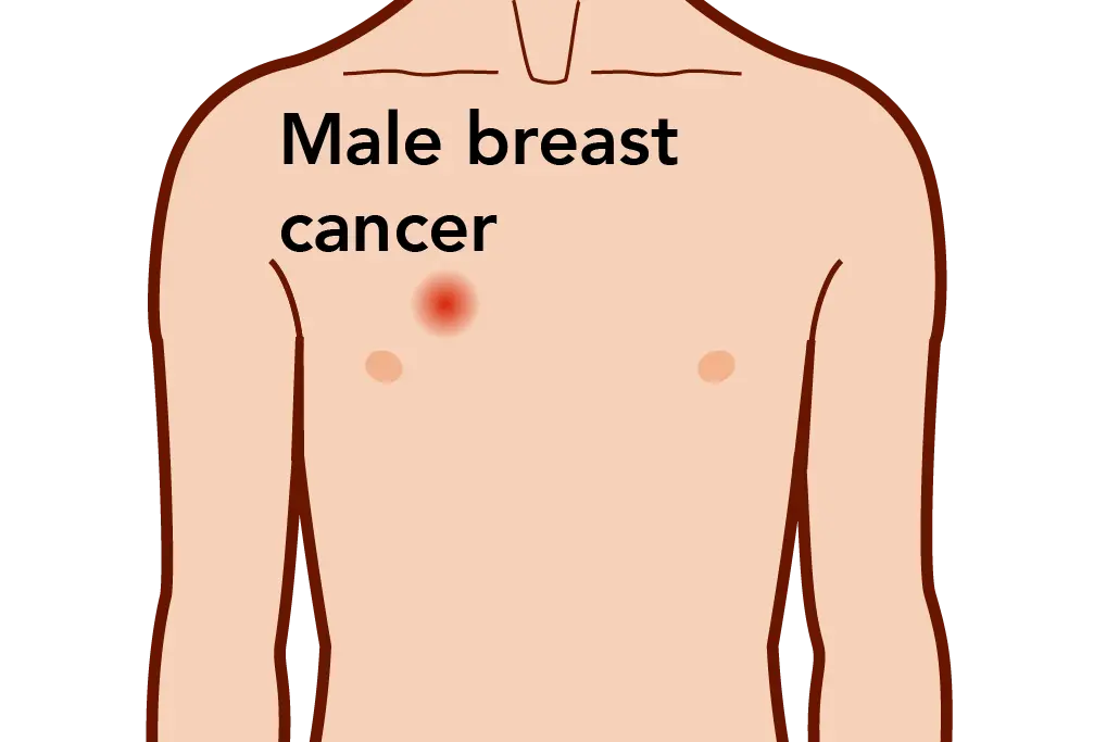 Althought breast cancer is much more common in women, men can develop it as well.