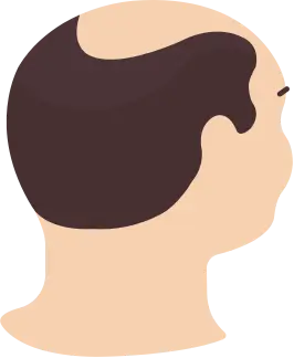 Hairloss in a horseshoe-like pattern is characteristic for male-pattern baldness.
