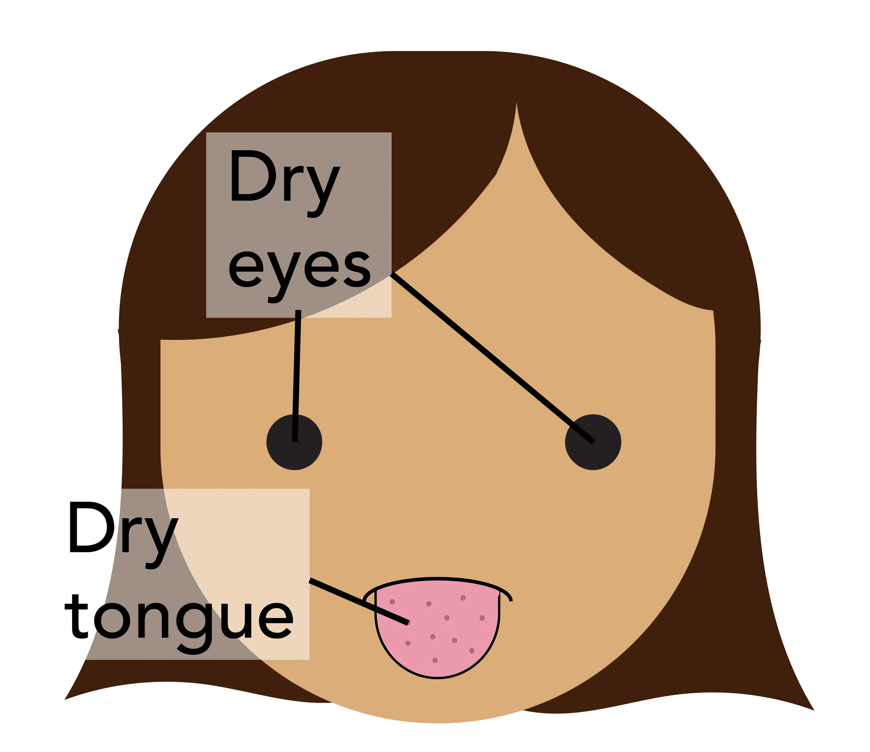 Dry eyes and tongue are typical symptoms of Sjögren's syndrome.