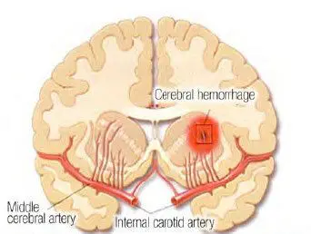 Lacunar storkes occur when small arteries that are located deep in the brain become occluded.