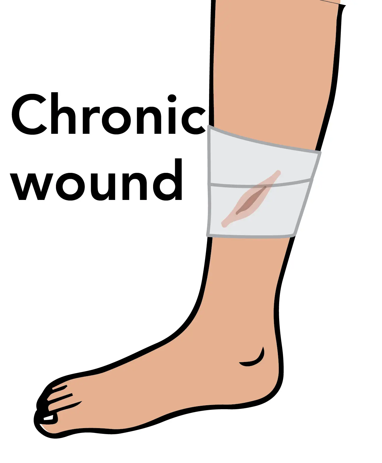 Chronic wounds often have a characteristic microbiome.