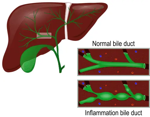 Primary biliary cholangitis causes inflammtion and obstruction of bile ducts in the liver.