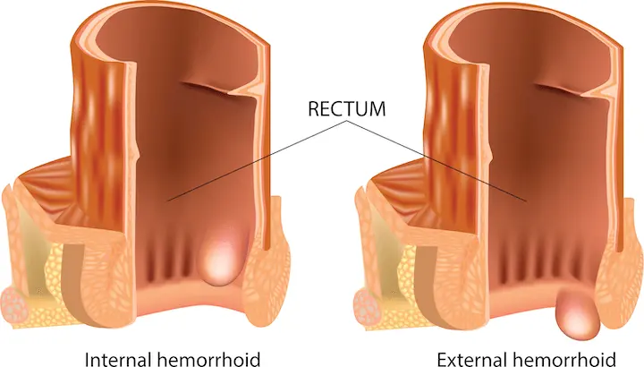 Hemorrhoids can be internal or external.