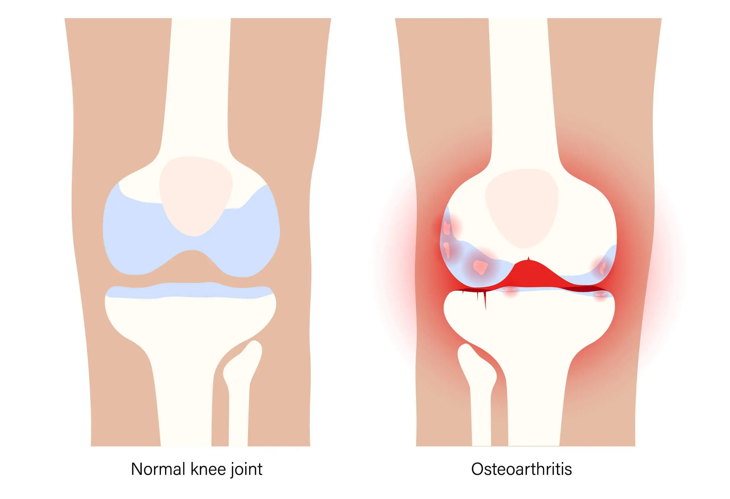 Osteoarthritis leads to inflammation in joints.
