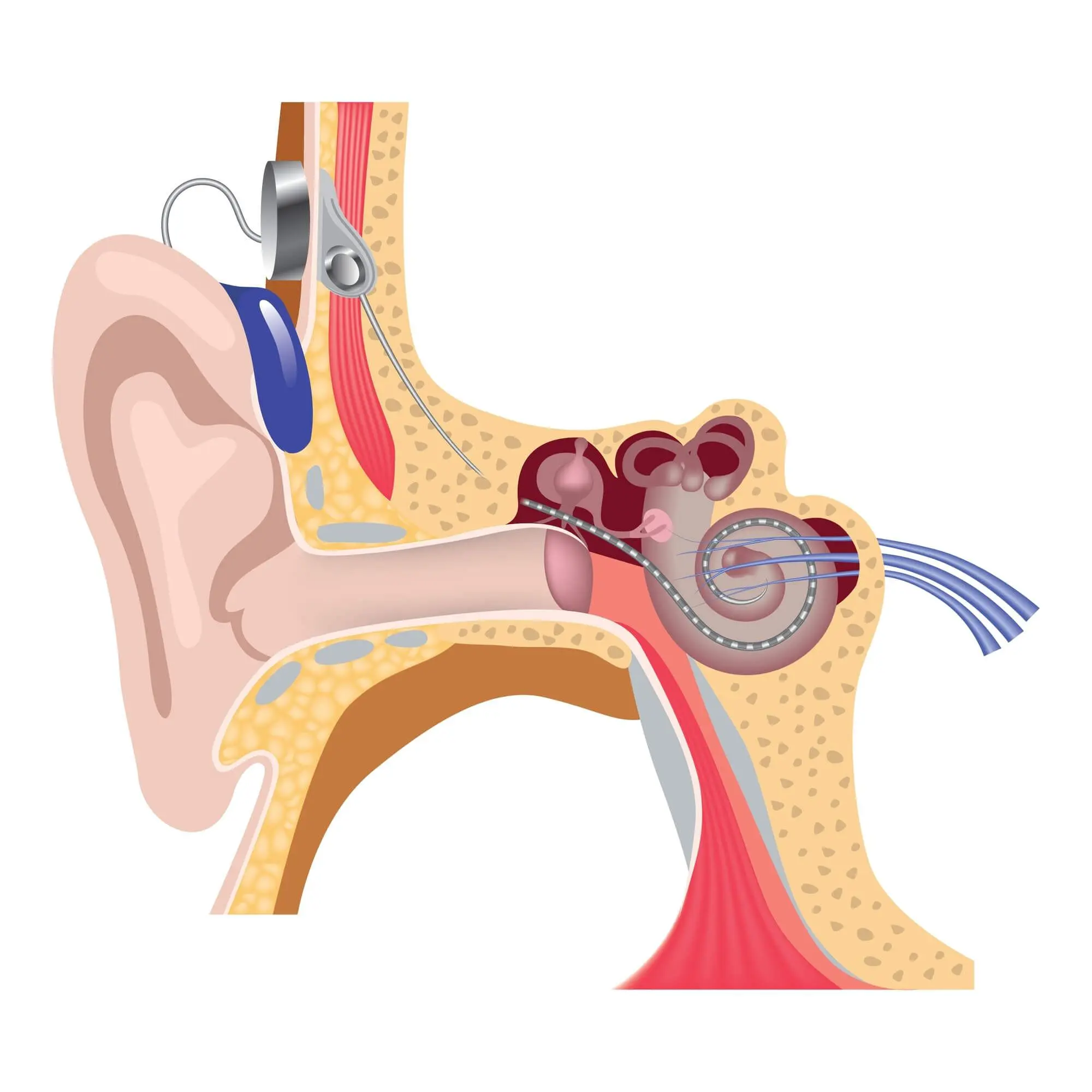 The bones of the middle ear become enlarged in otosclerosis