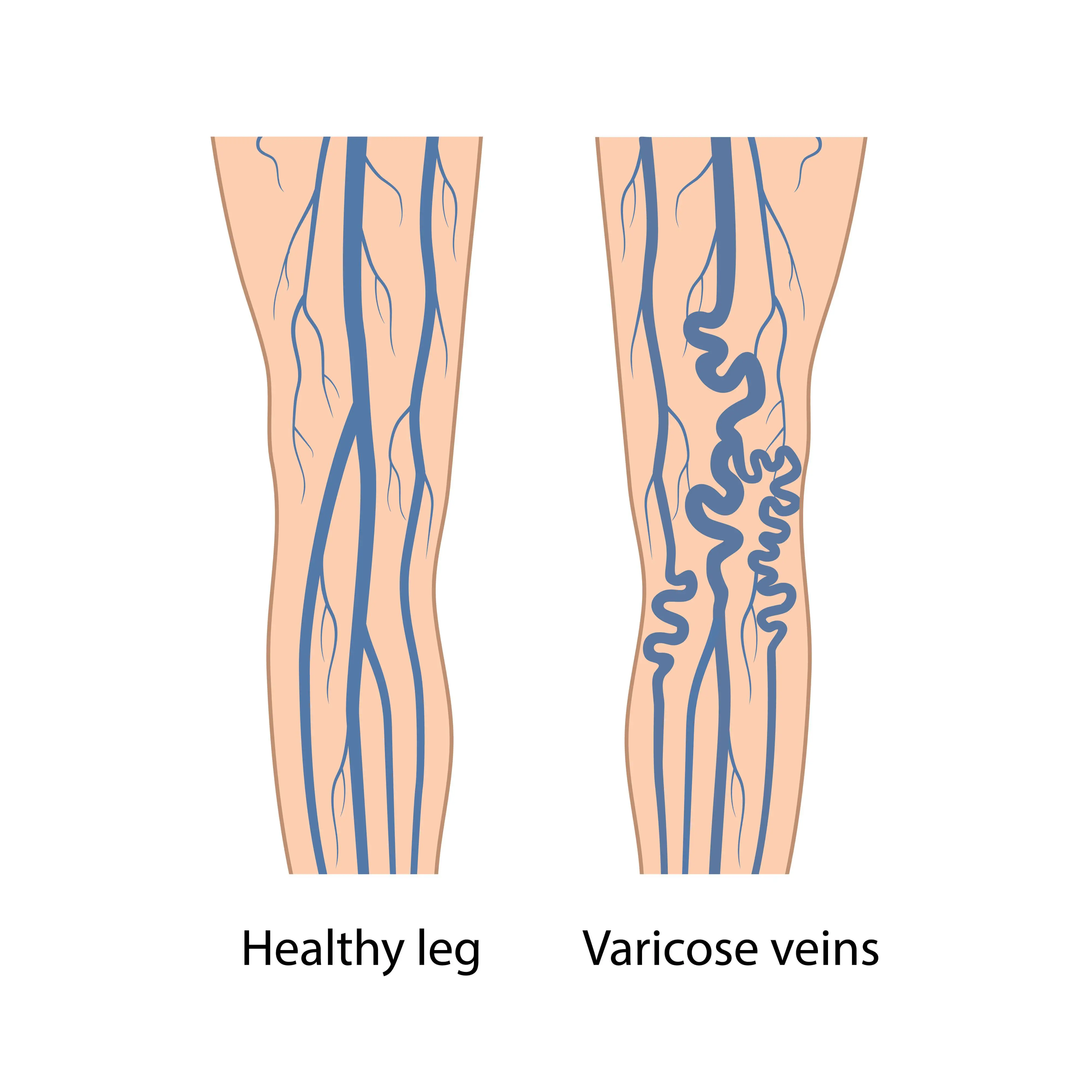 Varicose veins are enlarged and wind around.